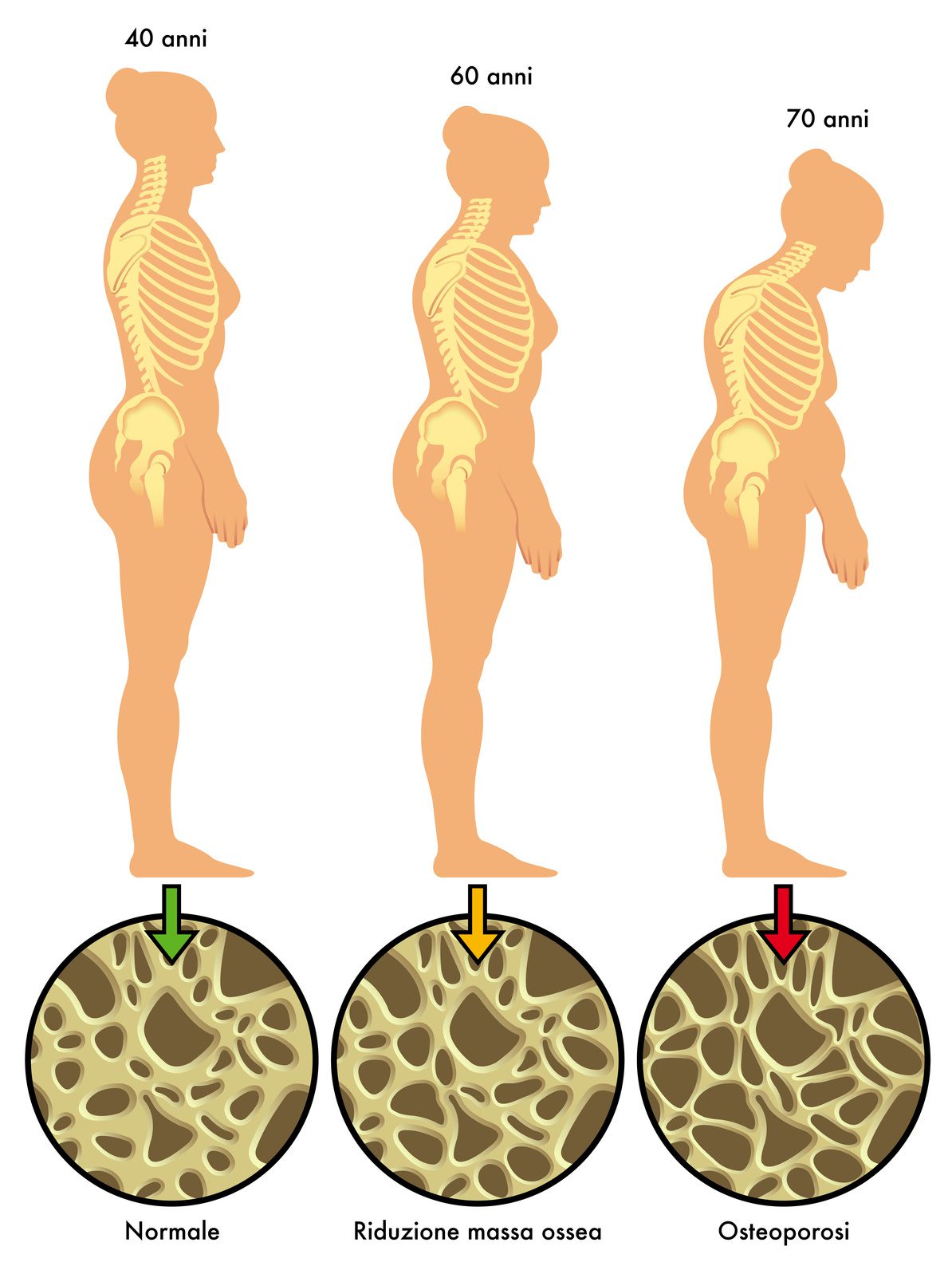 Menopausia y osteoporosis Huesos